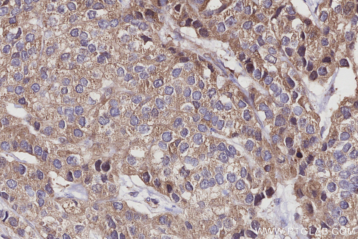 Immunohistochemical analysis of paraffin-embedded human stomach cancer tissue slide using KHC2976 (GTSE1 IHC Kit).
