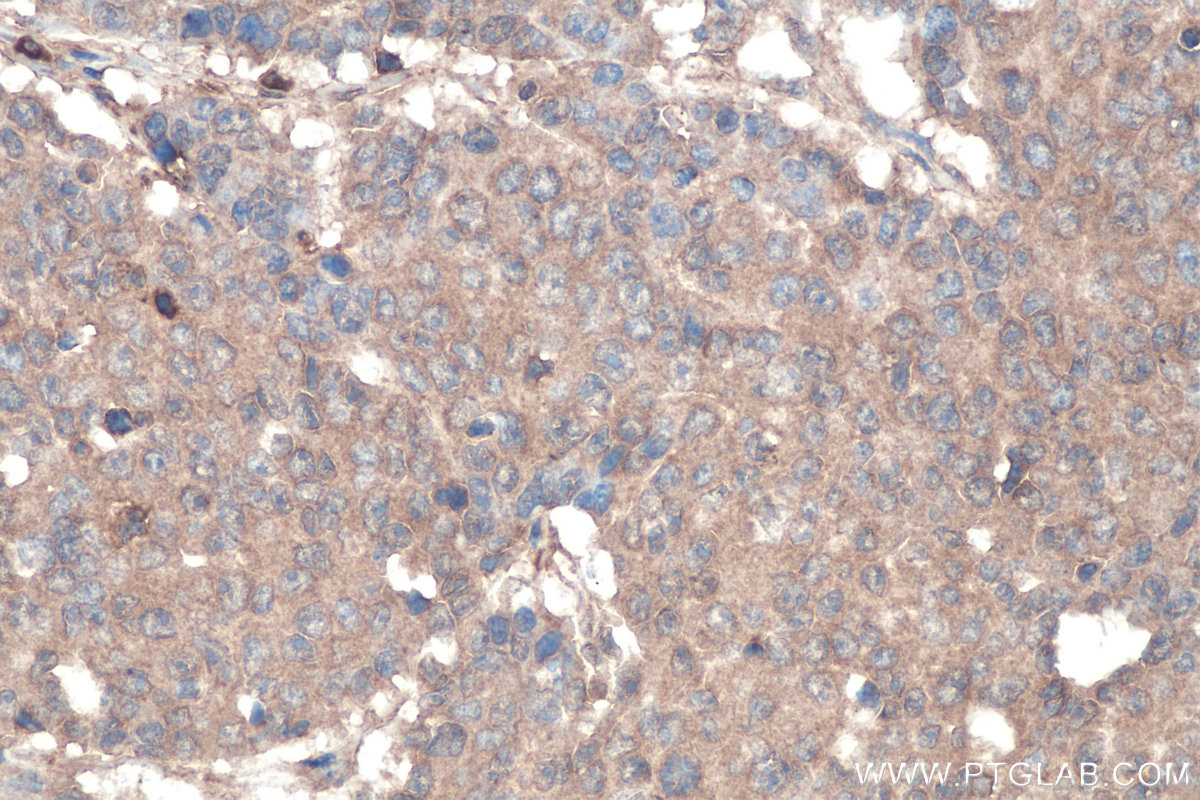 Immunohistochemical analysis of paraffin-embedded human colon cancer tissue slide using KHC0904 (GYG1 IHC Kit).