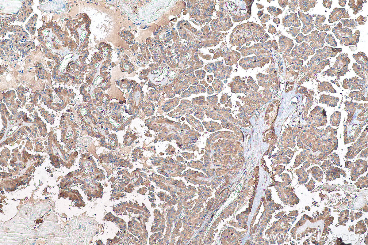 Immunohistochemical analysis of paraffin-embedded human thyroid cancer tissue slide using KHC0904 (GYG1 IHC Kit).