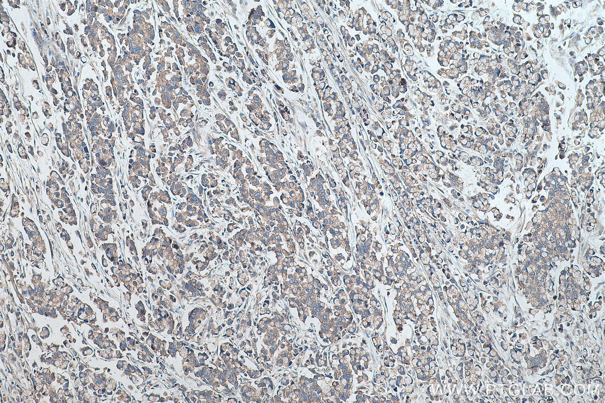 Immunohistochemical analysis of paraffin-embedded human colon cancer tissue slide using KHC0498 (GYS1 IHC Kit).