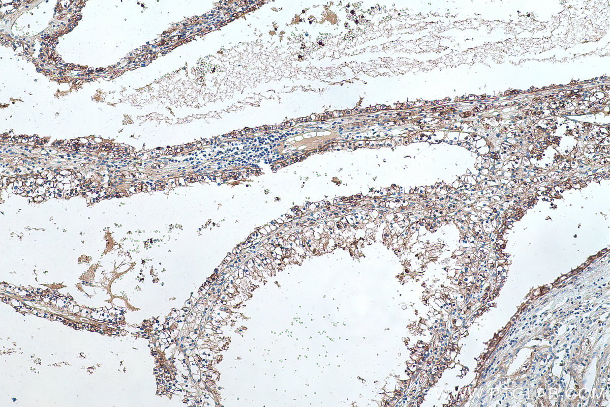 Immunohistochemical analysis of paraffin-embedded human renal cell carcinoma tissue slide using KHC0498 (GYS1 IHC Kit).