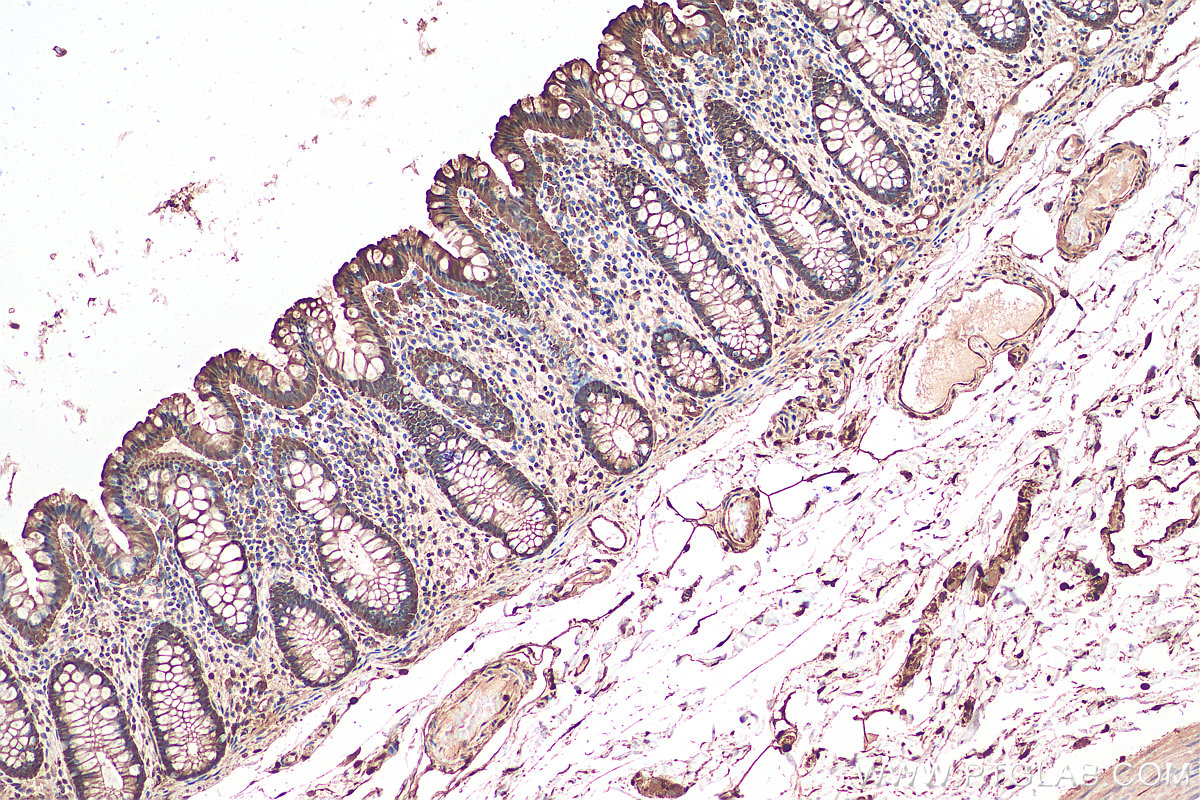Immunohistochemical analysis of paraffin-embedded human colon cancer tissue slide using KHC0035 (Galectin-3 IHC Kit).