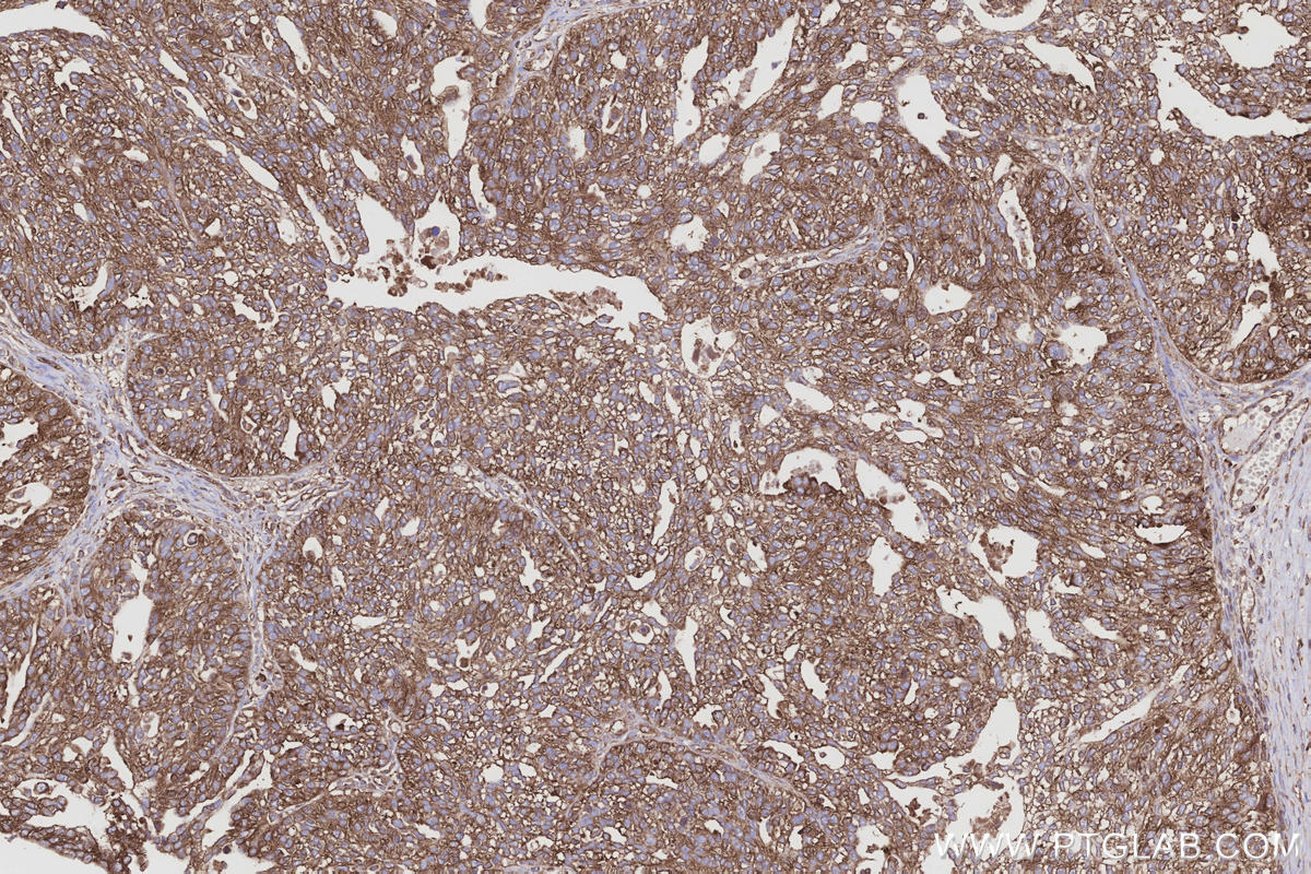 Immunohistochemical analysis of paraffin-embedded human ovary cancer tissue slide using KHC3214 (GlnRS IHC Kit).