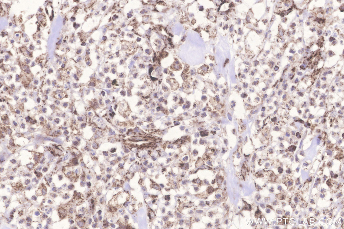 Immunohistochemical analysis of paraffin-embedded human colon cancer tissue slide using KHC3282 (Glutaredoxin 5 IHC Kit).