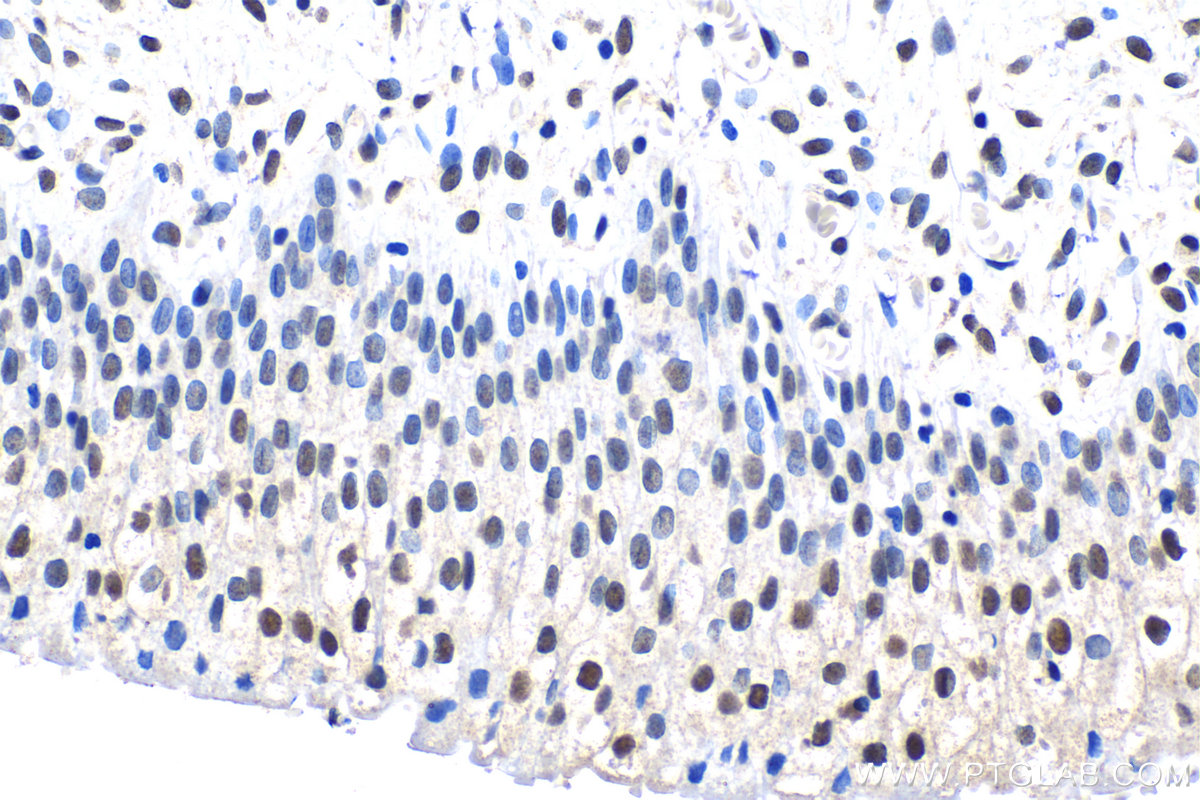 Immunohistochemical analysis of paraffin-embedded human urothelial carcinoma tissue slide using KHC1551 (H2AX IHC Kit).