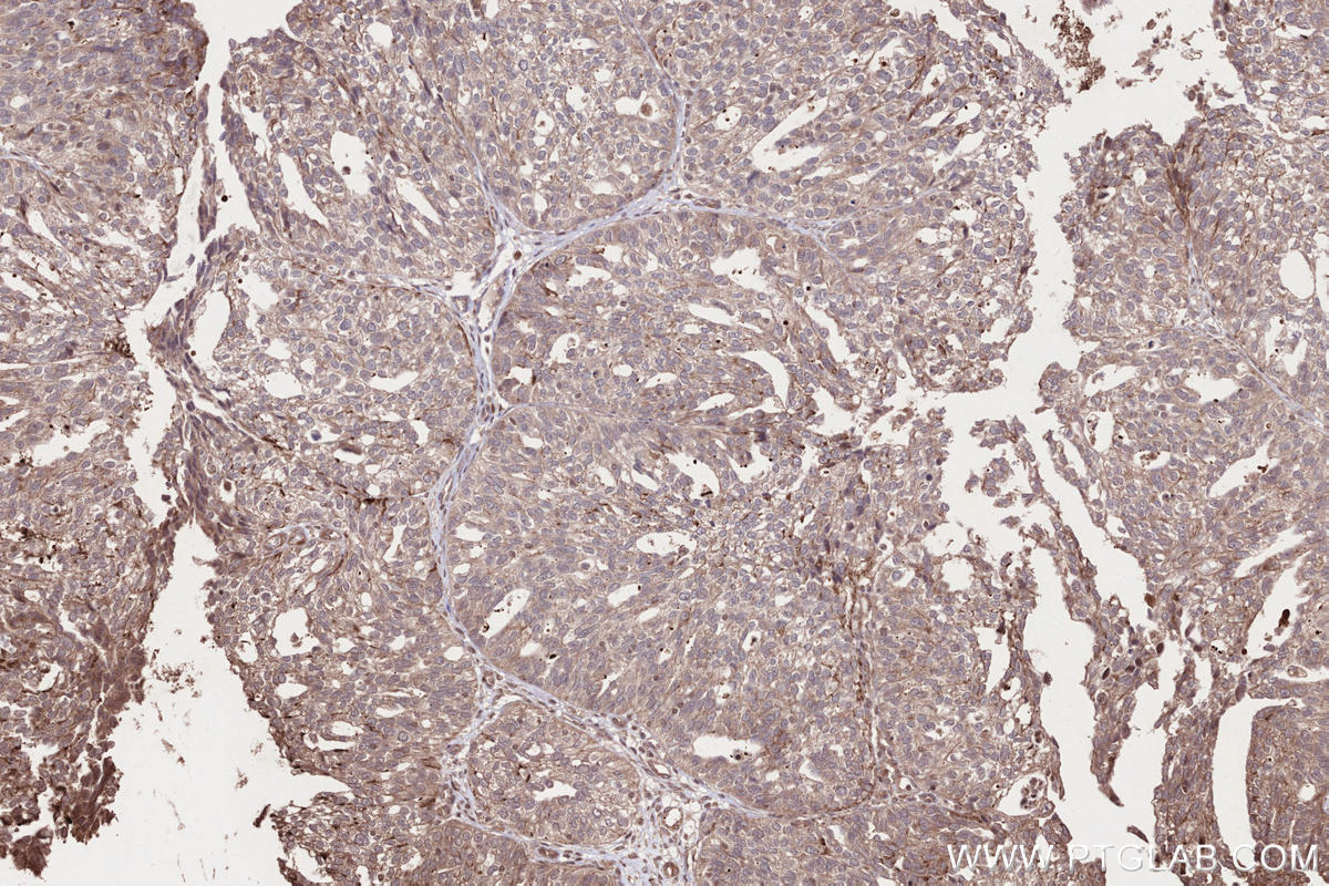 Immunohistochemical analysis of paraffin-embedded human ovary cancer tissue slide using KHC2661 (HACE1 IHC Kit).