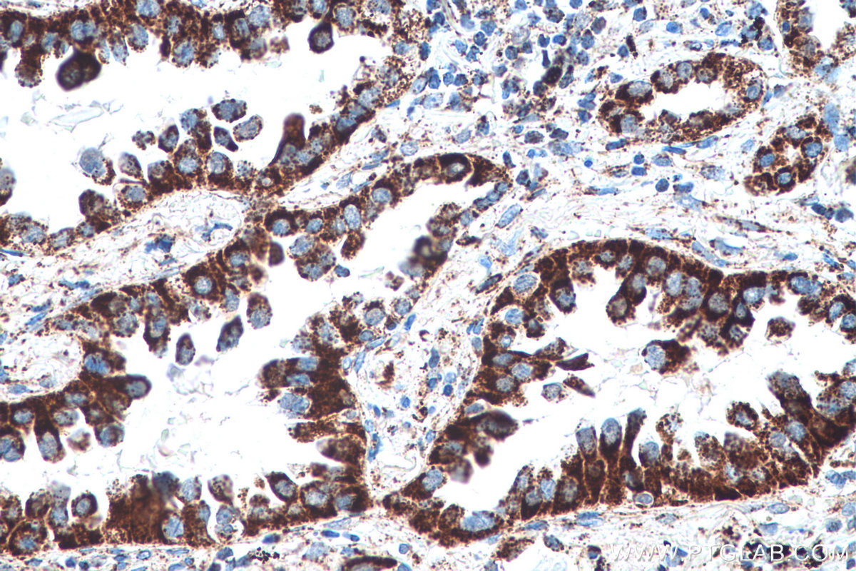 Immunohistochemical analysis of paraffin-embedded human lung cancer tissue slide using KHC0552 (HADH IHC Kit).