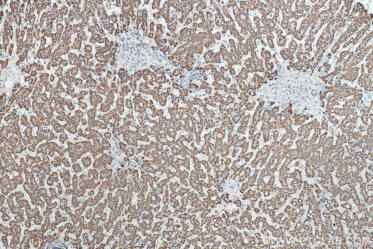 Immunohistochemical analysis of paraffin-embedded human liver cancer tissue slide using KHC0552 (HADH IHC Kit).