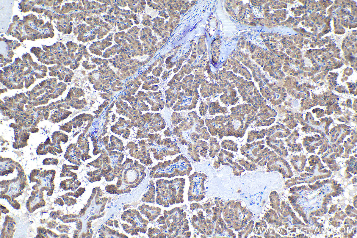 Immunohistochemical analysis of paraffin-embedded human thyroid cancer tissue slide using KHC1047 (HAGH IHC Kit).