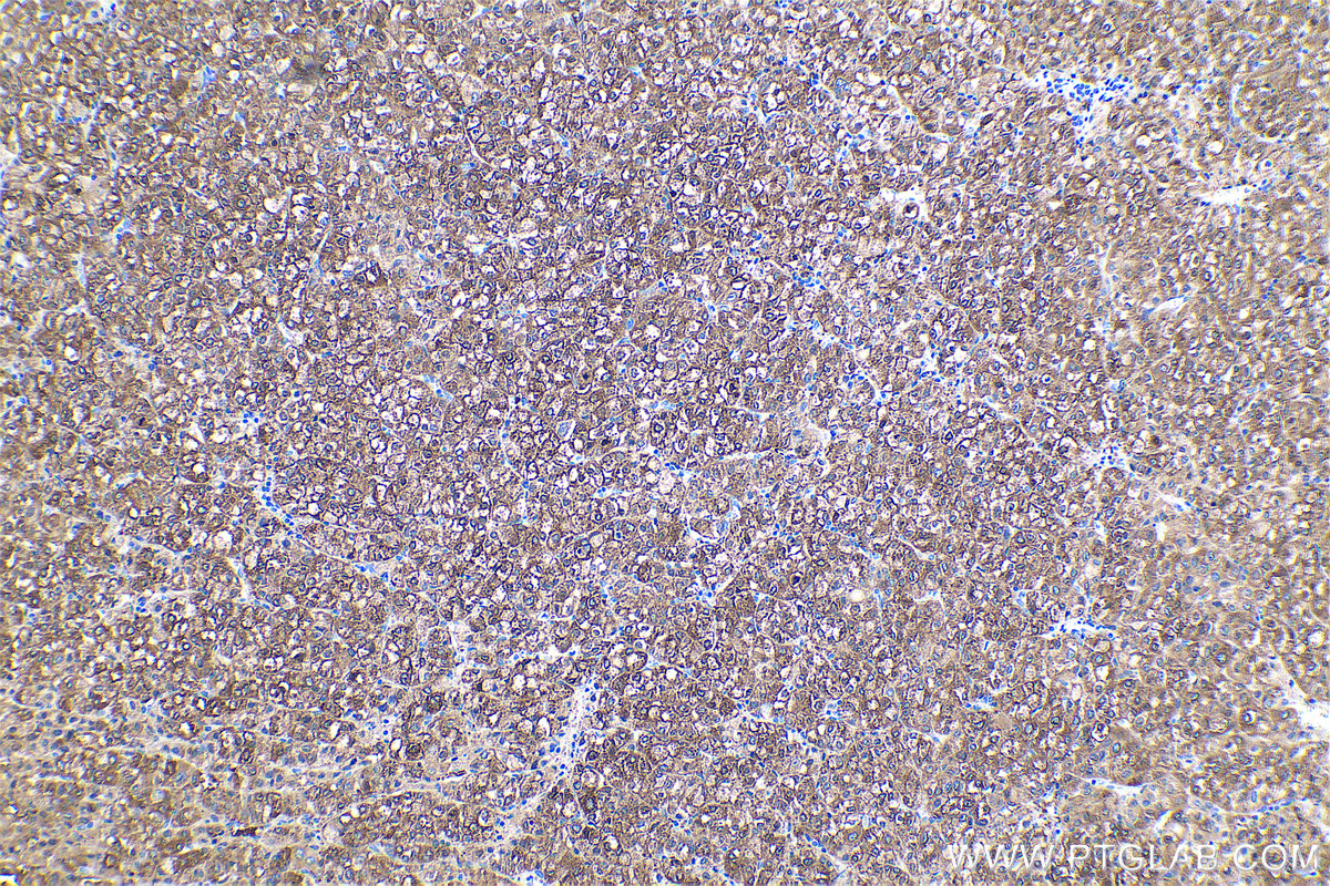 Immunohistochemical analysis of paraffin-embedded human liver cancer tissue slide using KHC0487 (HAL IHC Kit).