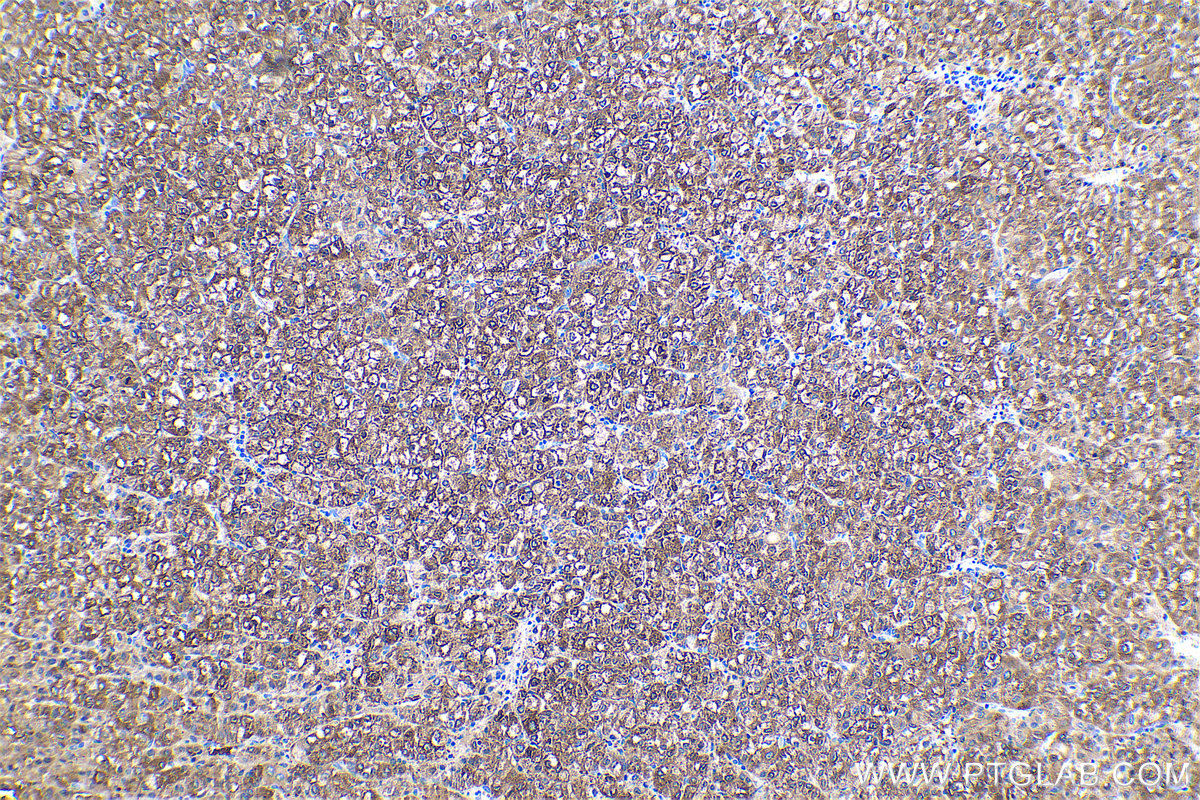 Immunohistochemical analysis of paraffin-embedded human liver cancer tissue slide using KHC0487 (HAL IHC Kit).