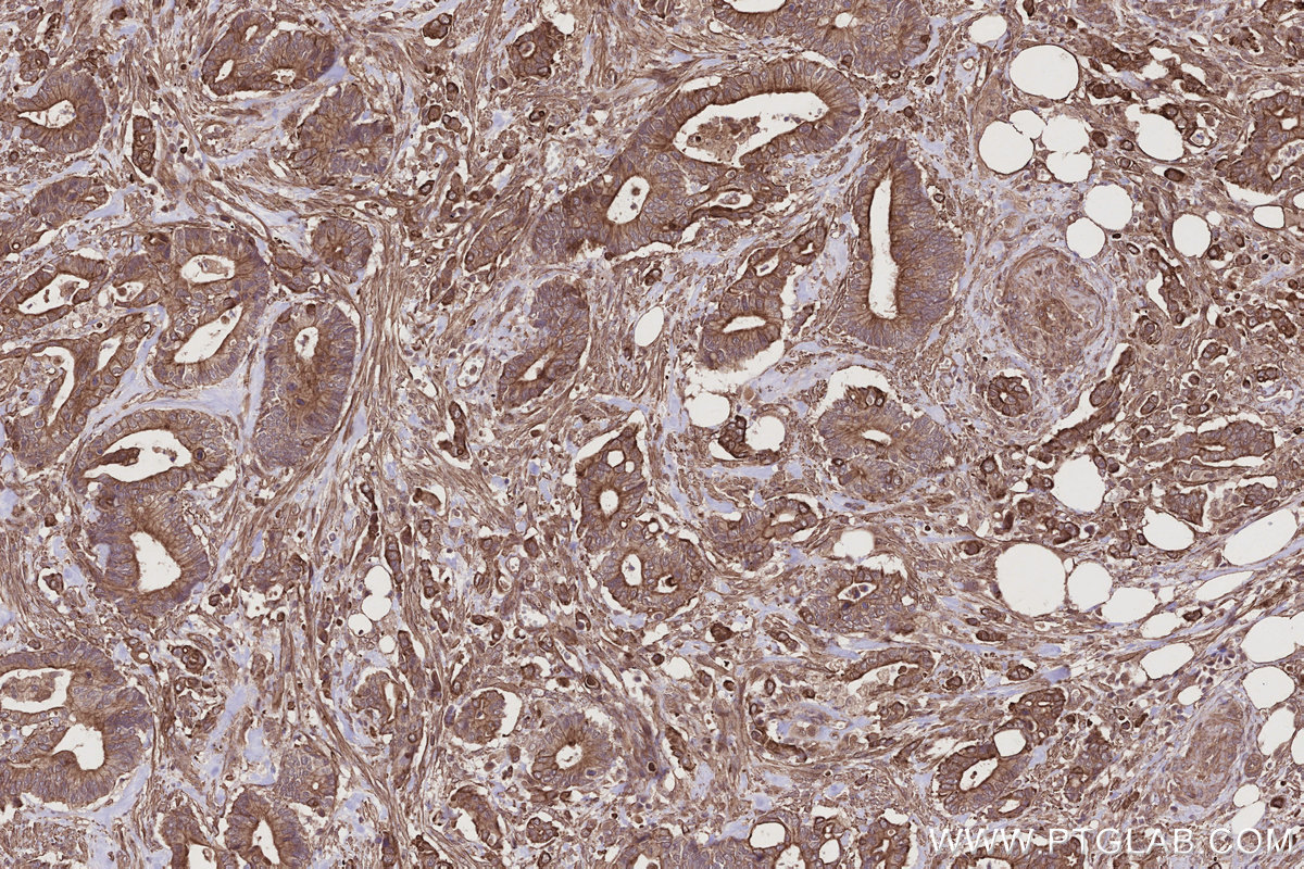 Immunohistochemical analysis of paraffin-embedded human rectal cancer tissue slide using KHC2782 (HAUS1 IHC Kit).