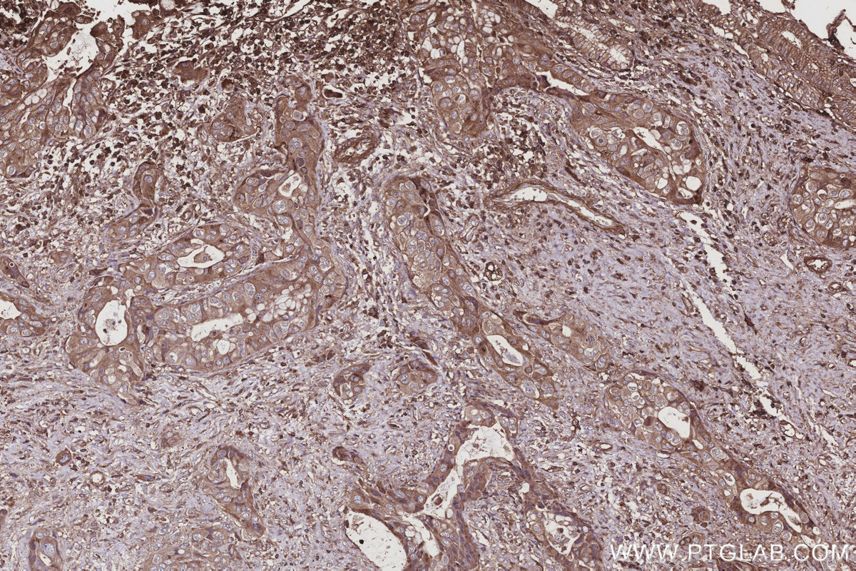 Immunohistochemical analysis of paraffin-embedded human pancreas cancer tissue slide using KHC2918 (HAUS4 IHC Kit).