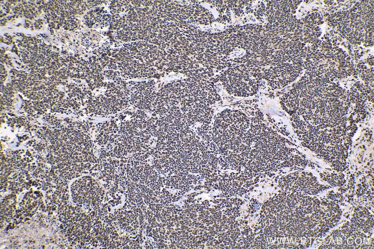 Immunohistochemical analysis of paraffin-embedded human lung cancer tissue slide using KHC1619 (HCFC1 IHC Kit).