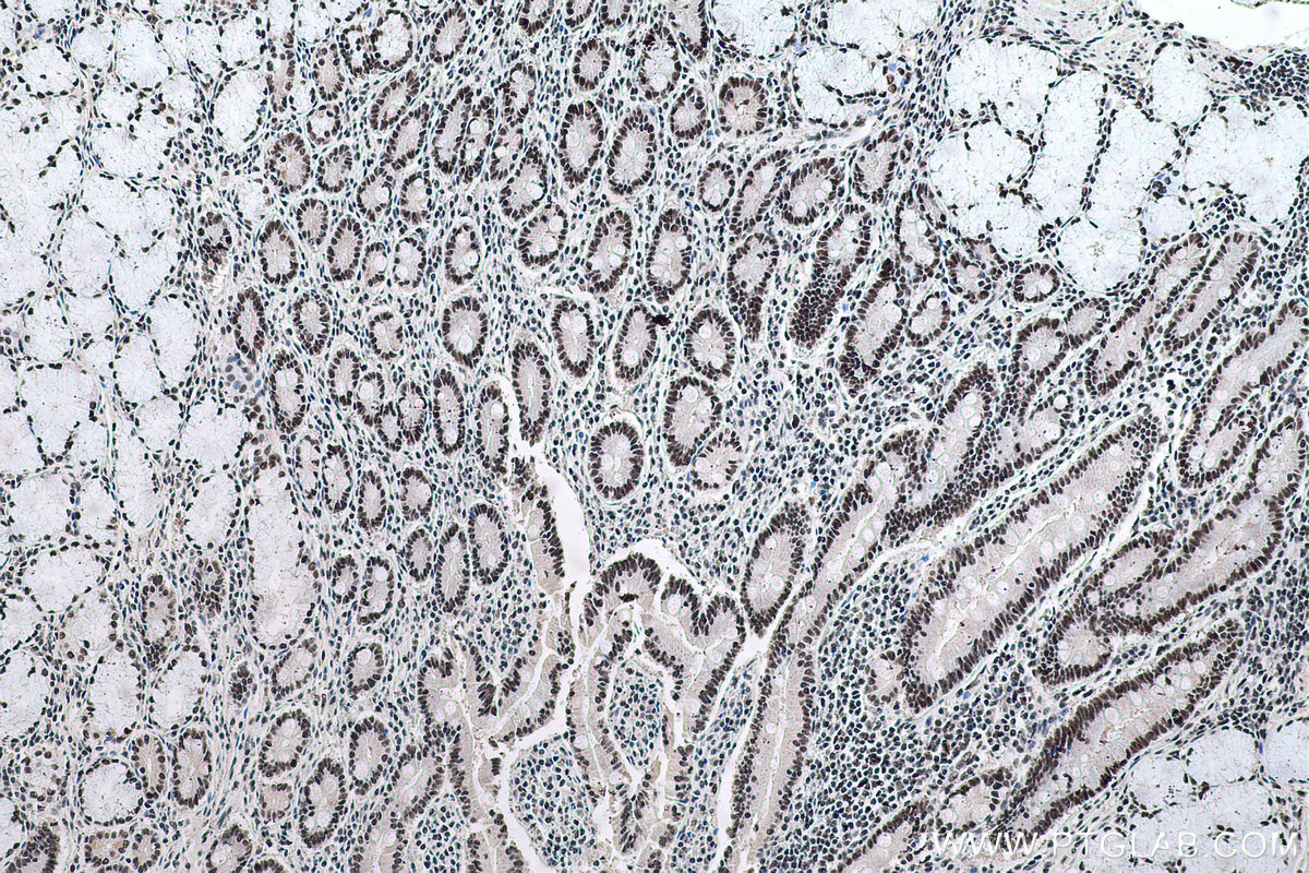 Immunohistochemical analysis of paraffin-embedded human stomach cancer tissue slide using KHC0613 (HDAC1 IHC Kit).