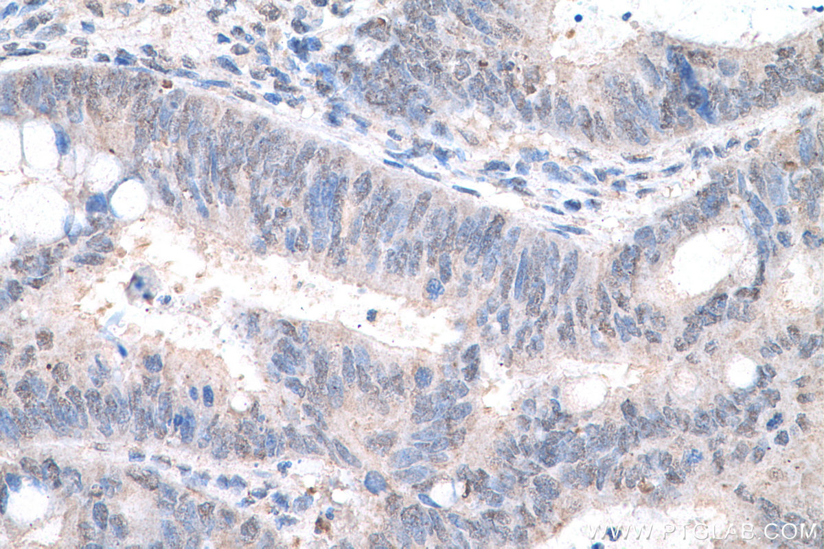 Immunohistochemical analysis of paraffin-embedded human colon cancer tissue slide using KHC0619 (HDAC11 IHC Kit).
