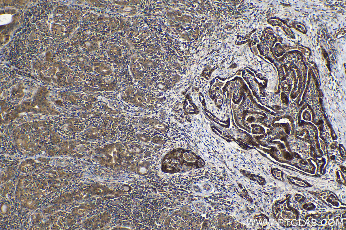 Immunohistochemical analysis of paraffin-embedded human thyroid cancer tissue slide using KHC2036 (HDDC2 IHC Kit).
