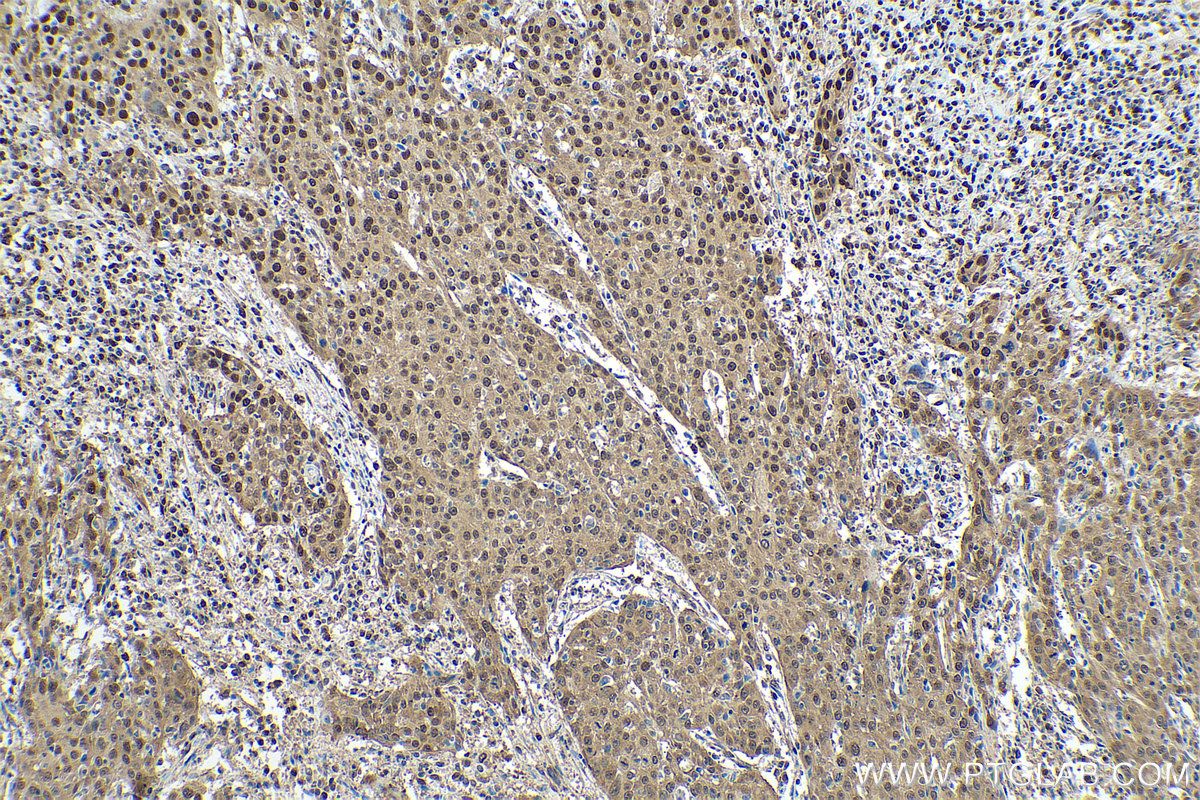 Immunohistochemical analysis of paraffin-embedded human cervical cancer tissue slide using KHC0898 (HDGF IHC Kit).