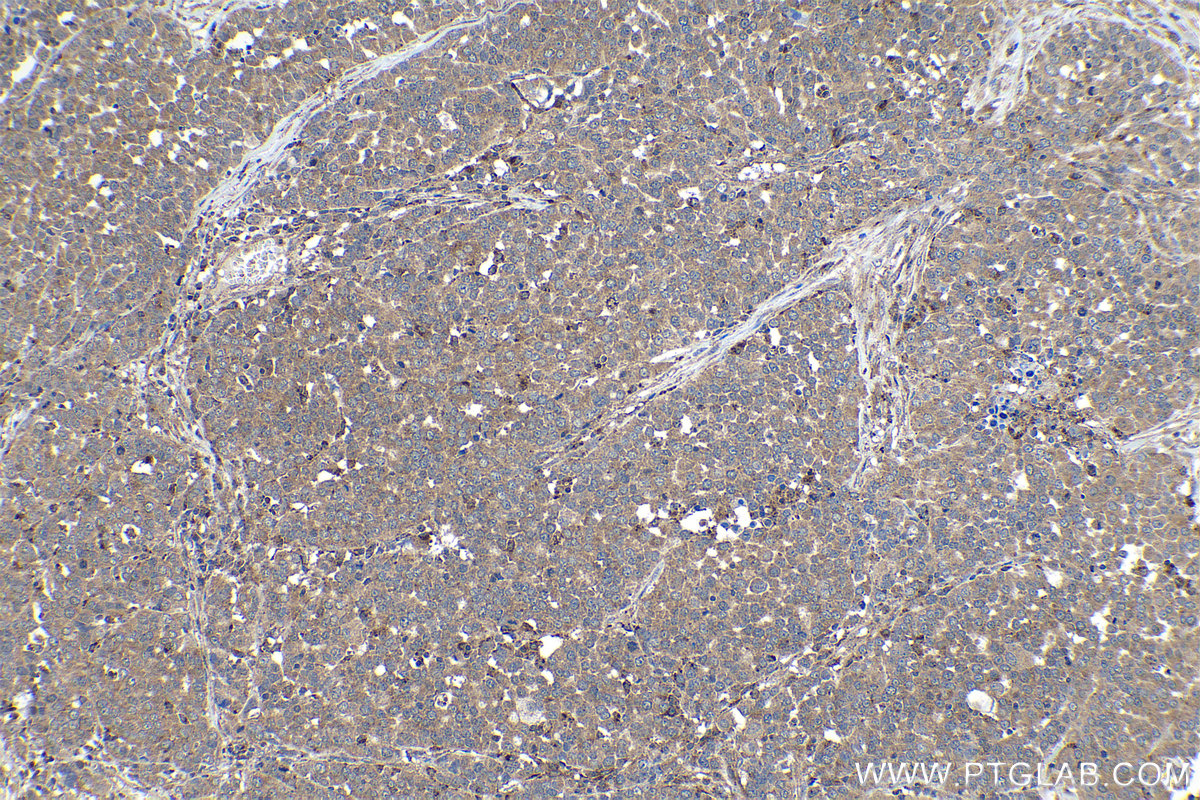 Immunohistochemical analysis of paraffin-embedded human ovary tumor tissue slide using KHC1133 (HEXB IHC Kit).