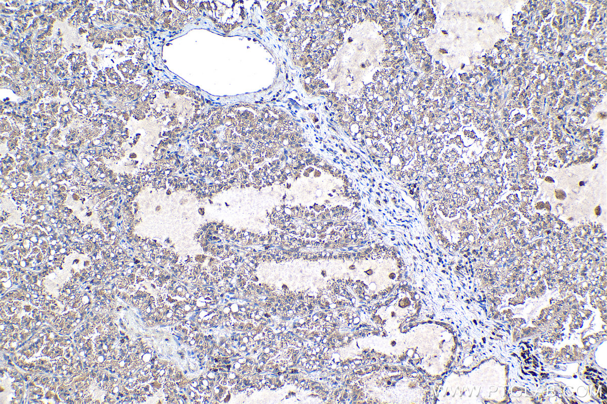 Immunohistochemical analysis of paraffin-embedded human lung cancer tissue slide using KHC1133 (HEXB IHC Kit).