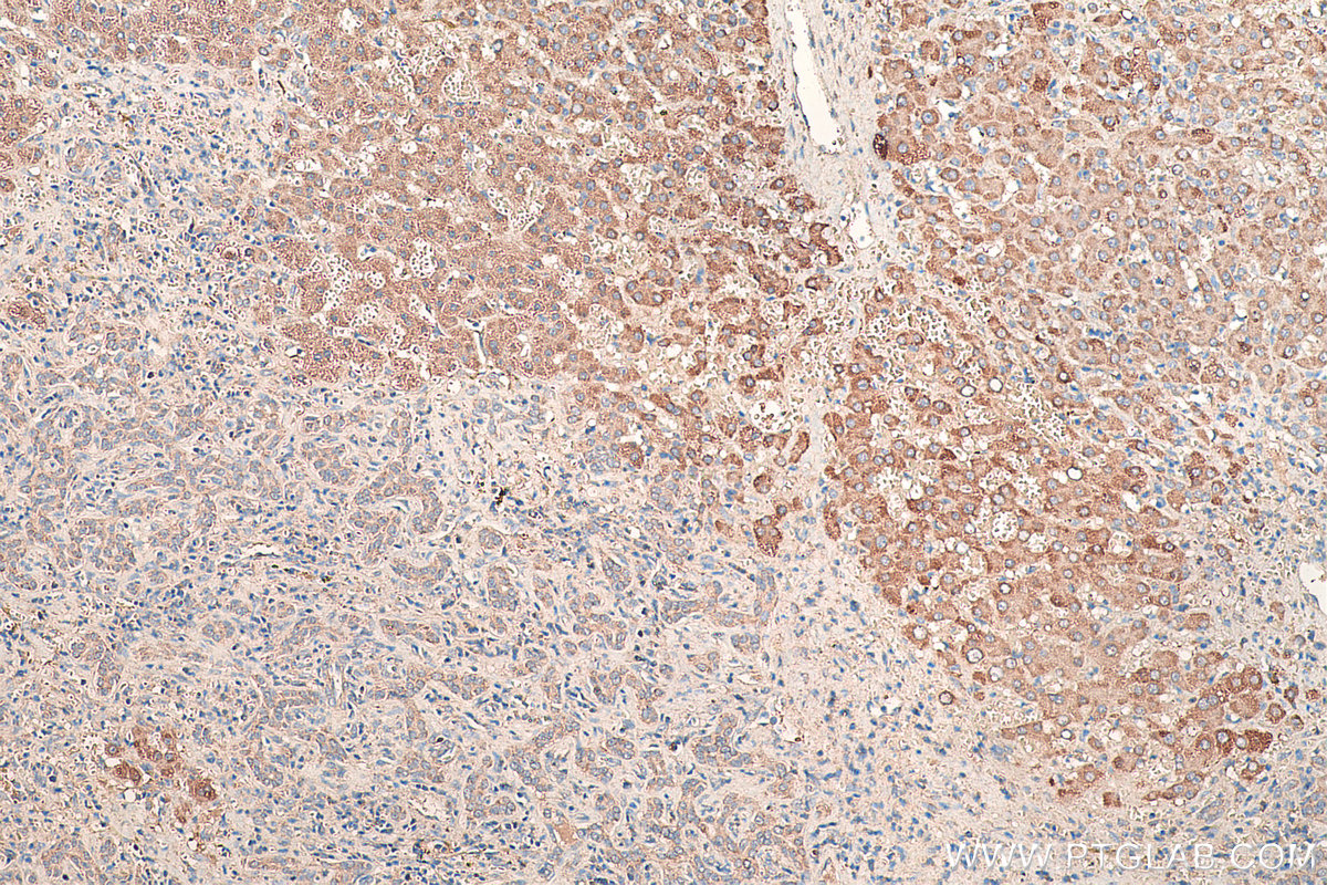 Immunohistochemical analysis of paraffin-embedded human liver cancer tissue slide using KHC0478 (HGF IHC Kit).