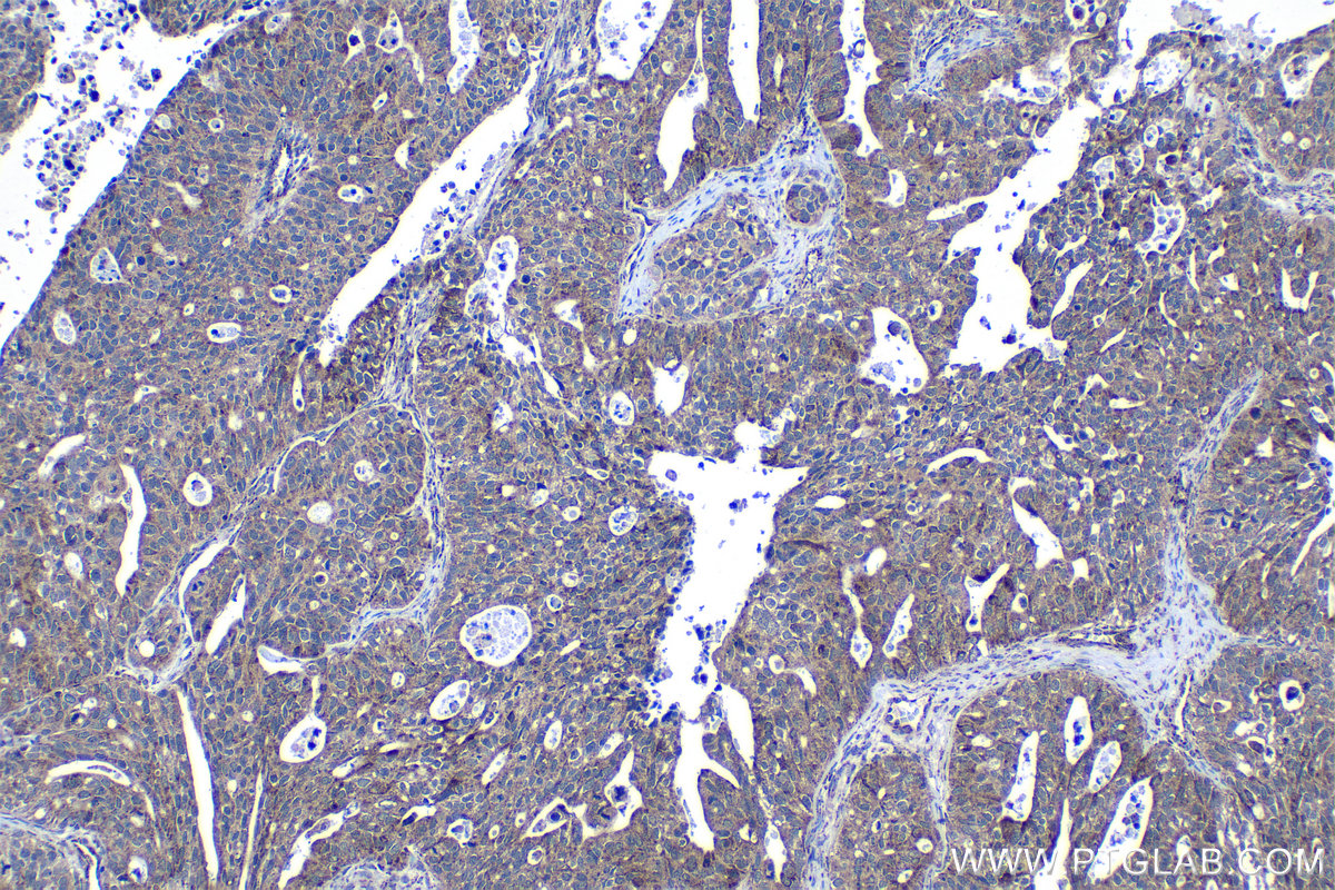 Immunohistochemical analysis of paraffin-embedded human ovary tumor tissue slide using KHC1310 (HIBCH IHC Kit).