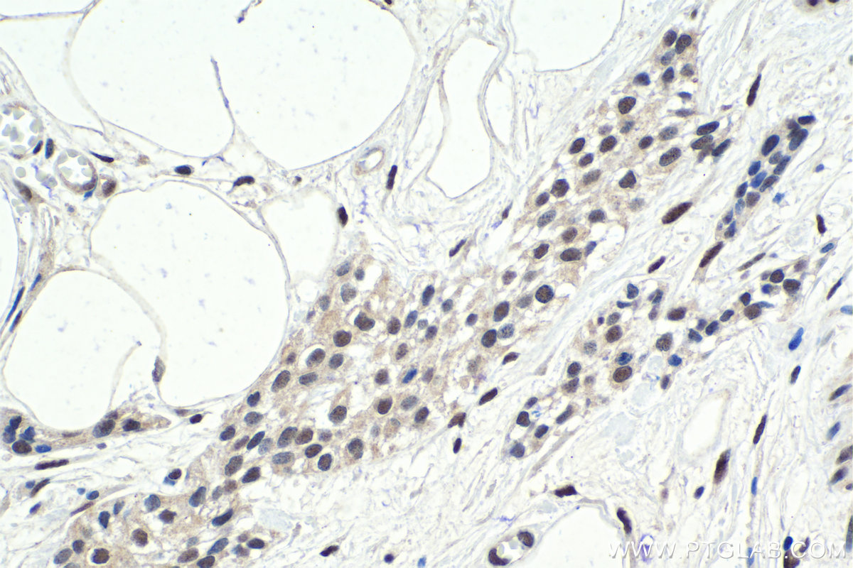 Immunohistochemical analysis of paraffin-embedded human urothelial carcinoma tissue slide using KHC1732 (HIC1 IHC Kit).