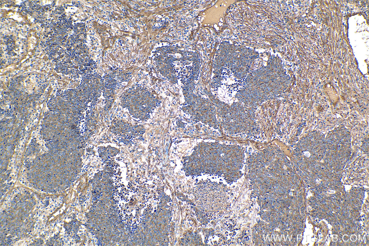 Immunohistochemical analysis of paraffin-embedded human lung cancer tissue slide using KHC1420 (HIP1 IHC Kit).