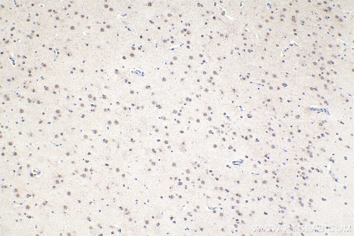 Immunohistochemical analysis of paraffin-embedded human gliomas tissue slide using KHC1929 (HIPK2 IHC Kit).