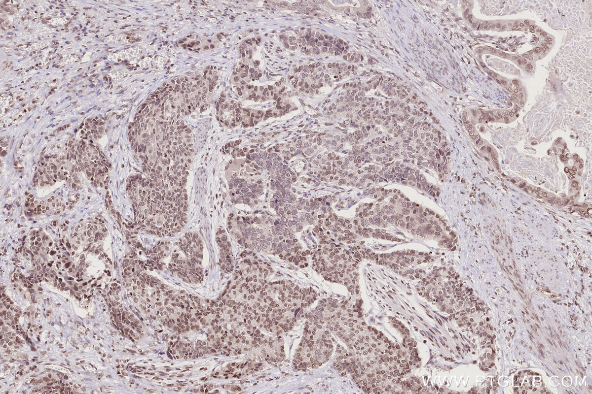 Immunohistochemical analysis of paraffin-embedded human stomach cancer tissue slide using KHC2771 (HIST1H2AC IHC Kit).