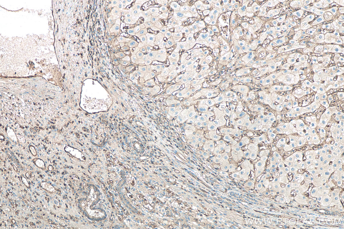 Immunohistochemical analysis of paraffin-embedded human liver cancer tissue slide using KHC0093 (HLA class I ABC IHC Kit).