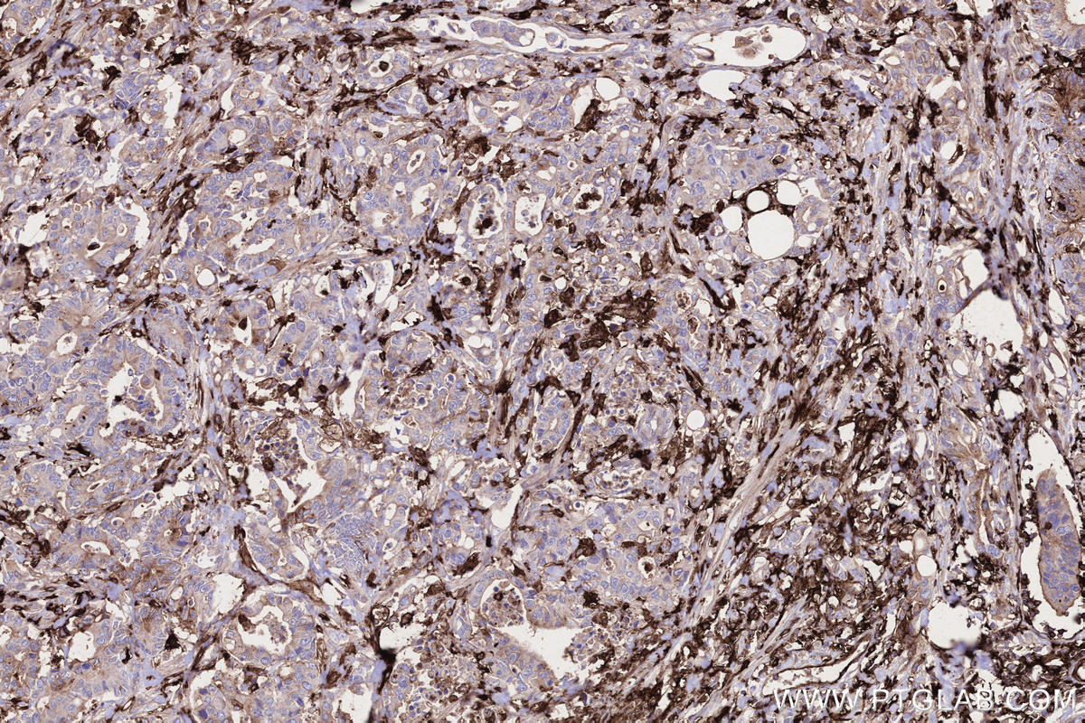 Immunohistochemical analysis of paraffin-embedded human rectal cancer tissue slide using KHC2757 (HLA-DRA IHC Kit).