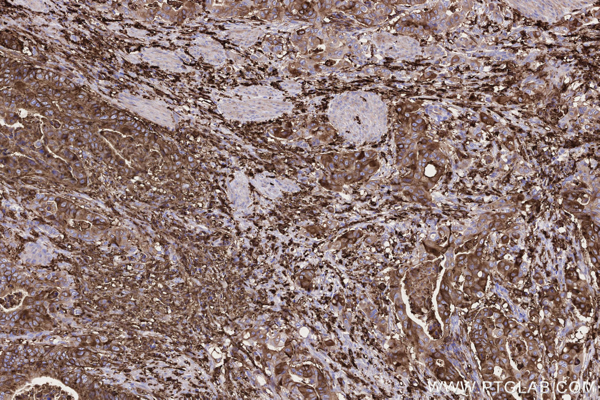 Immunohistochemical analysis of paraffin-embedded human stomach cancer tissue slide using KHC2757 (HLA-DRA IHC Kit).