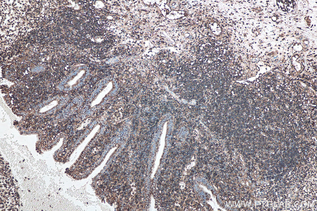 Immunohistochemical analysis of paraffin-embedded human appendicitis tissue slide using KHC0089 (HLA-E IHC Kit).