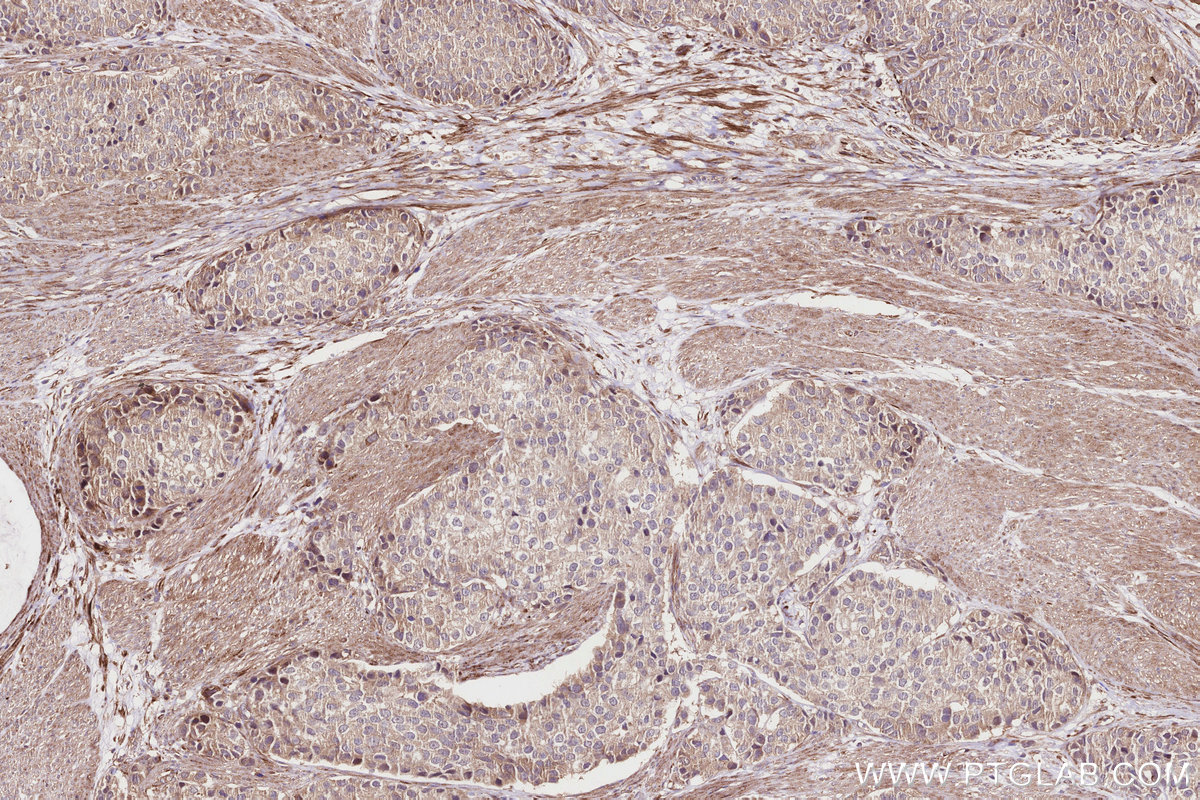 Immunohistochemical analysis of paraffin-embedded human stomach cancer tissue slide using KHC2831 (HMCN1 IHC Kit).