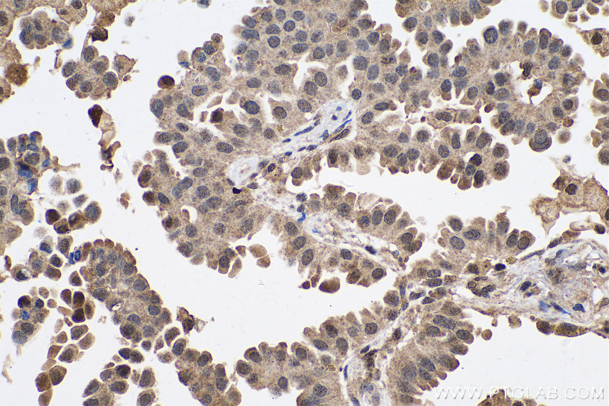 Immunohistochemical analysis of paraffin-embedded human lung cancer tissue slide using KHC0736 (HMGB1 IHC Kit).