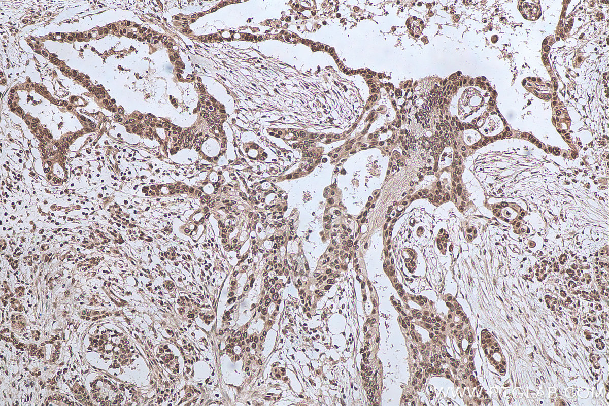 Immunohistochemical analysis of paraffin-embedded human pancreas cancer tissue slide using KHC0736 (HMGB1 IHC Kit).