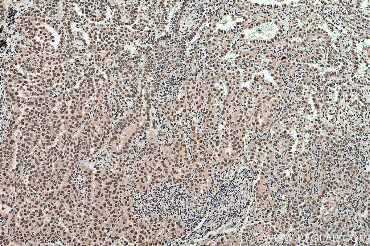 Immunohistochemical analysis of paraffin-embedded human lung cancer tissue slide using KHC0682 (HNRNPA1 IHC Kit).