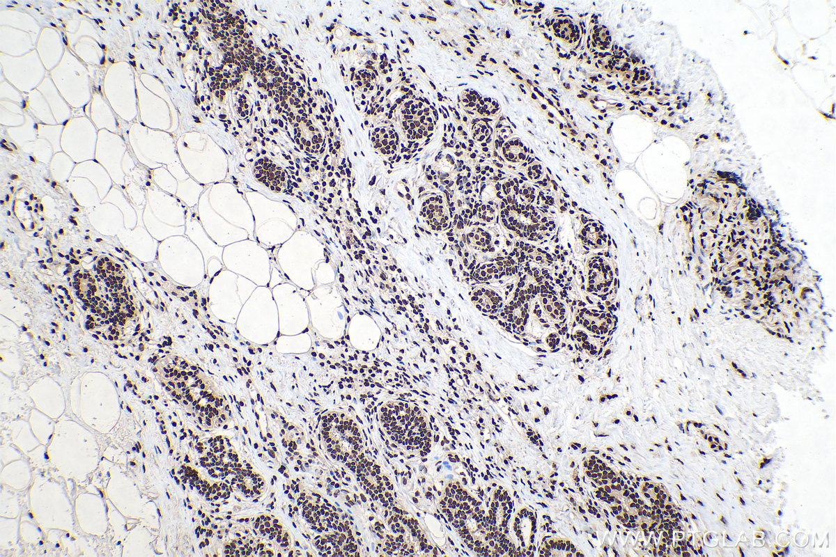 Immunohistochemical analysis of paraffin-embedded human breast cancer tissue slide using KHC0163 (HNRNPA2B1 IHC Kit).