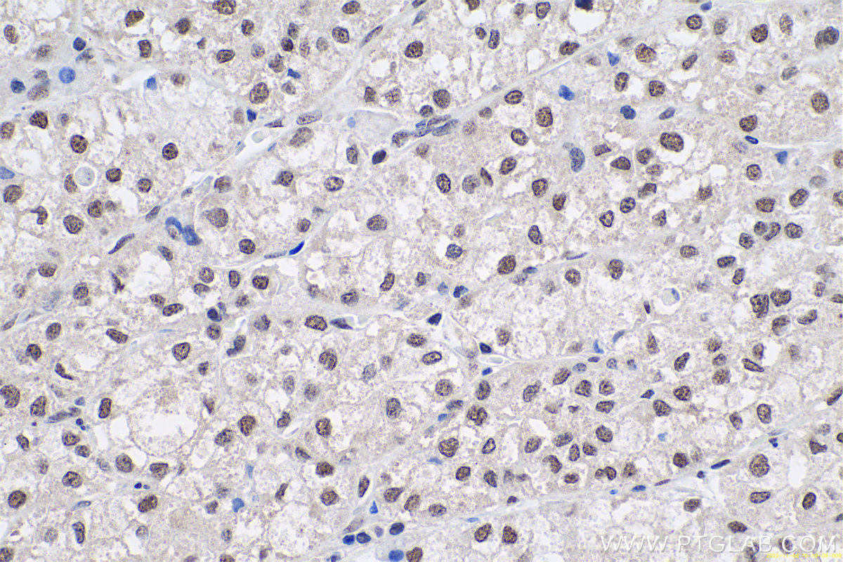 Immunohistochemical analysis of paraffin-embedded human liver cancer tissue slide using KHC0657 (HNRNPA3 IHC Kit).