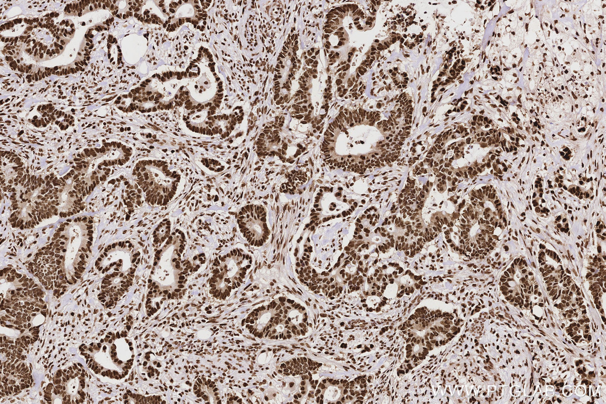 Immunohistochemical analysis of paraffin-embedded human rectal cancer tissue slide using KHC2847 (HNRNPAB IHC Kit).