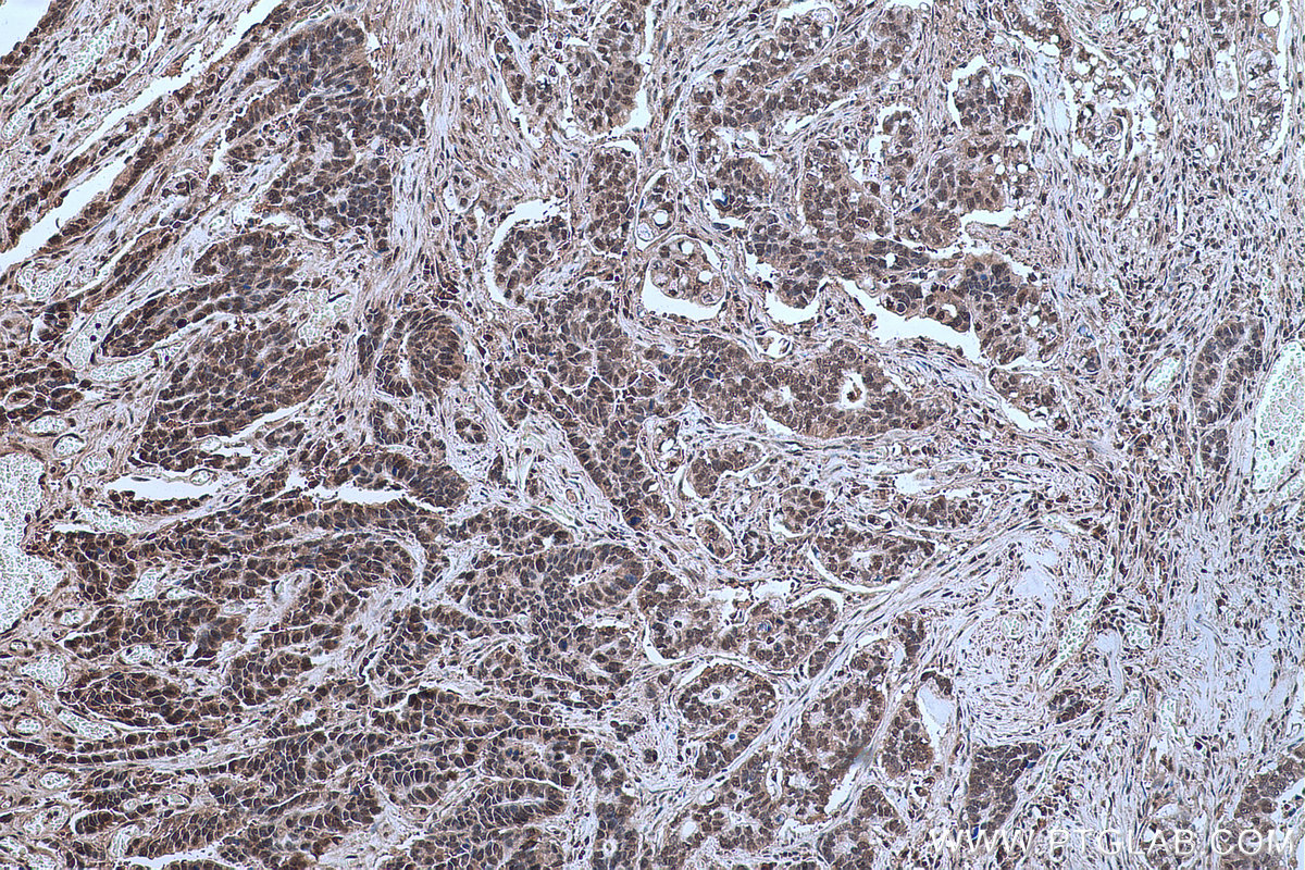 Immunohistochemical analysis of paraffin-embedded human stomach cancer tissue slide using KHC0669 (HNRNPU IHC Kit).