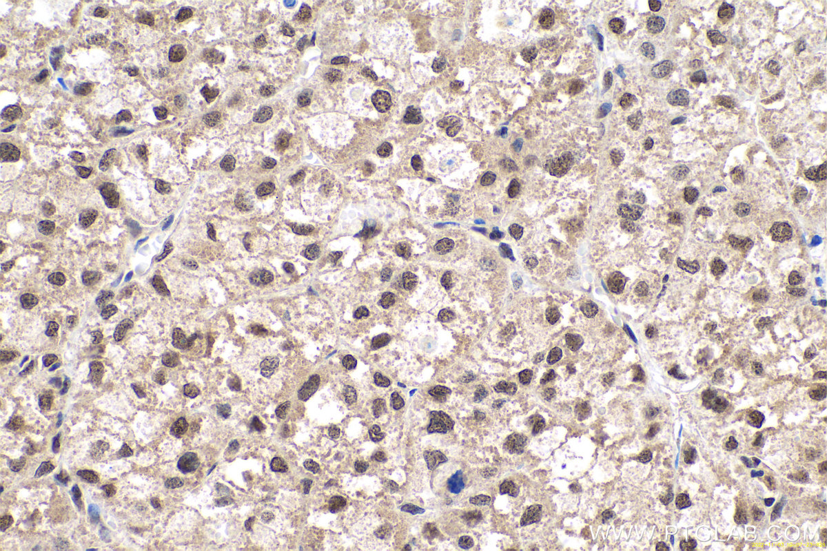 Immunohistochemical analysis of paraffin-embedded human liver cancer tissue slide using KHC0669 (HNRNPU IHC Kit).