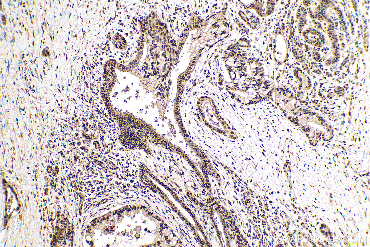 Immunohistochemical analysis of paraffin-embedded human pancreas cancer tissue slide using KHC0669 (HNRNPU IHC Kit).