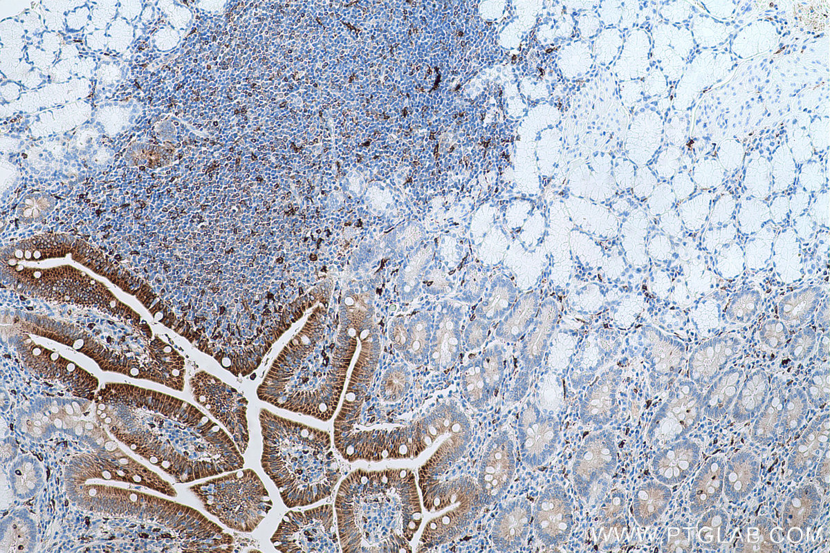 Immunohistochemical analysis of paraffin-embedded human stomach cancer tissue slide using KHC0624 (HO-1/HMOX1 IHC Kit).