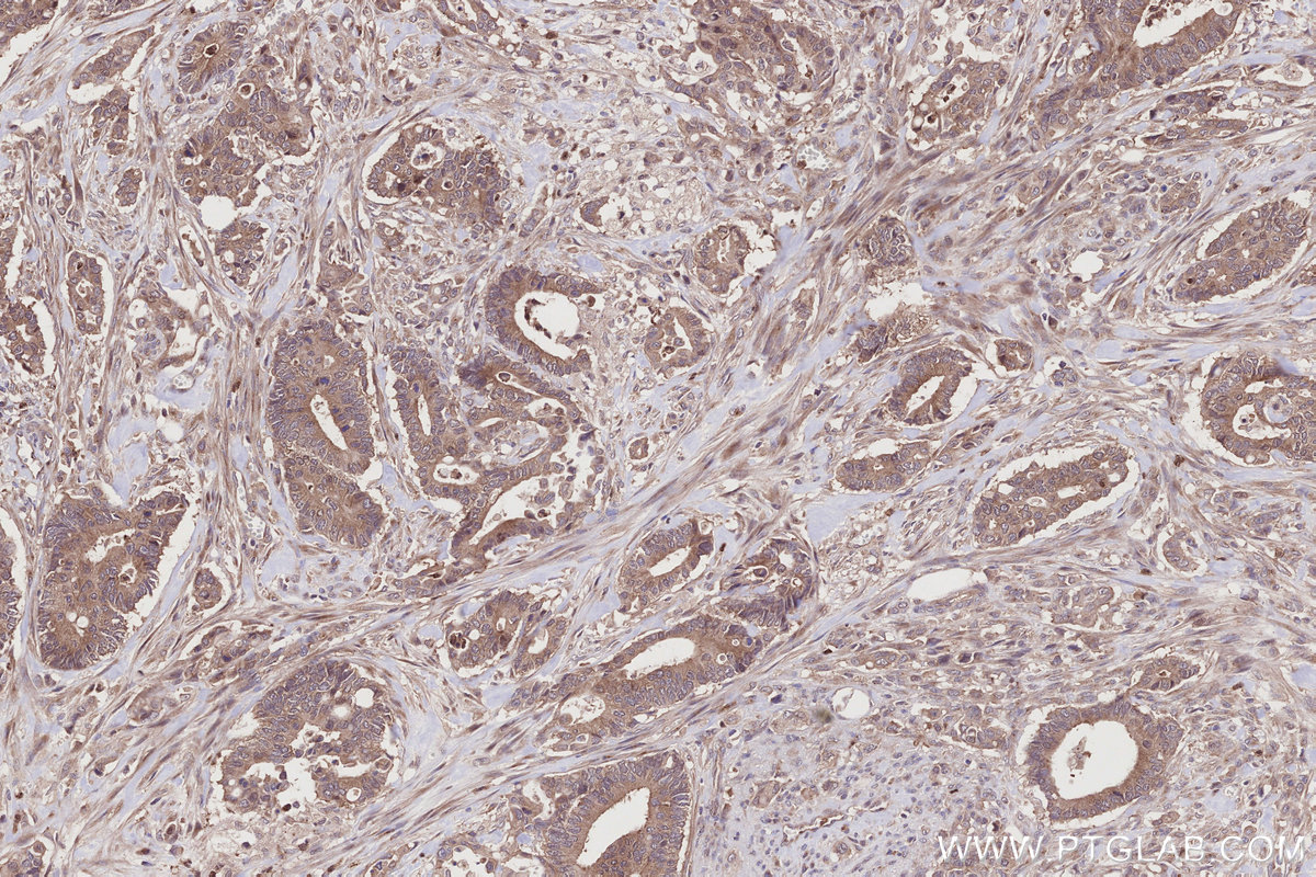 Immunohistochemical analysis of paraffin-embedded human rectal cancer tissue slide using KHC2788 (HOOK2 IHC Kit).
