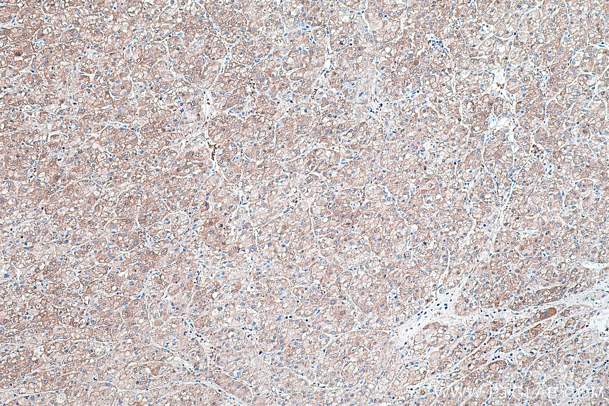 Immunohistochemical analysis of paraffin-embedded human liver cancer tissue slide using KHC0426 (HPRT1 IHC Kit).