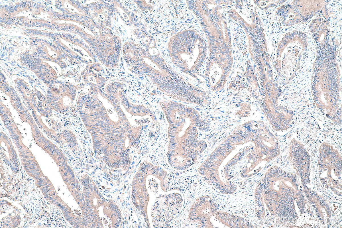 Immunohistochemical analysis of paraffin-embedded human colon cancer tissue slide using KHC0426 (HPRT1 IHC Kit).