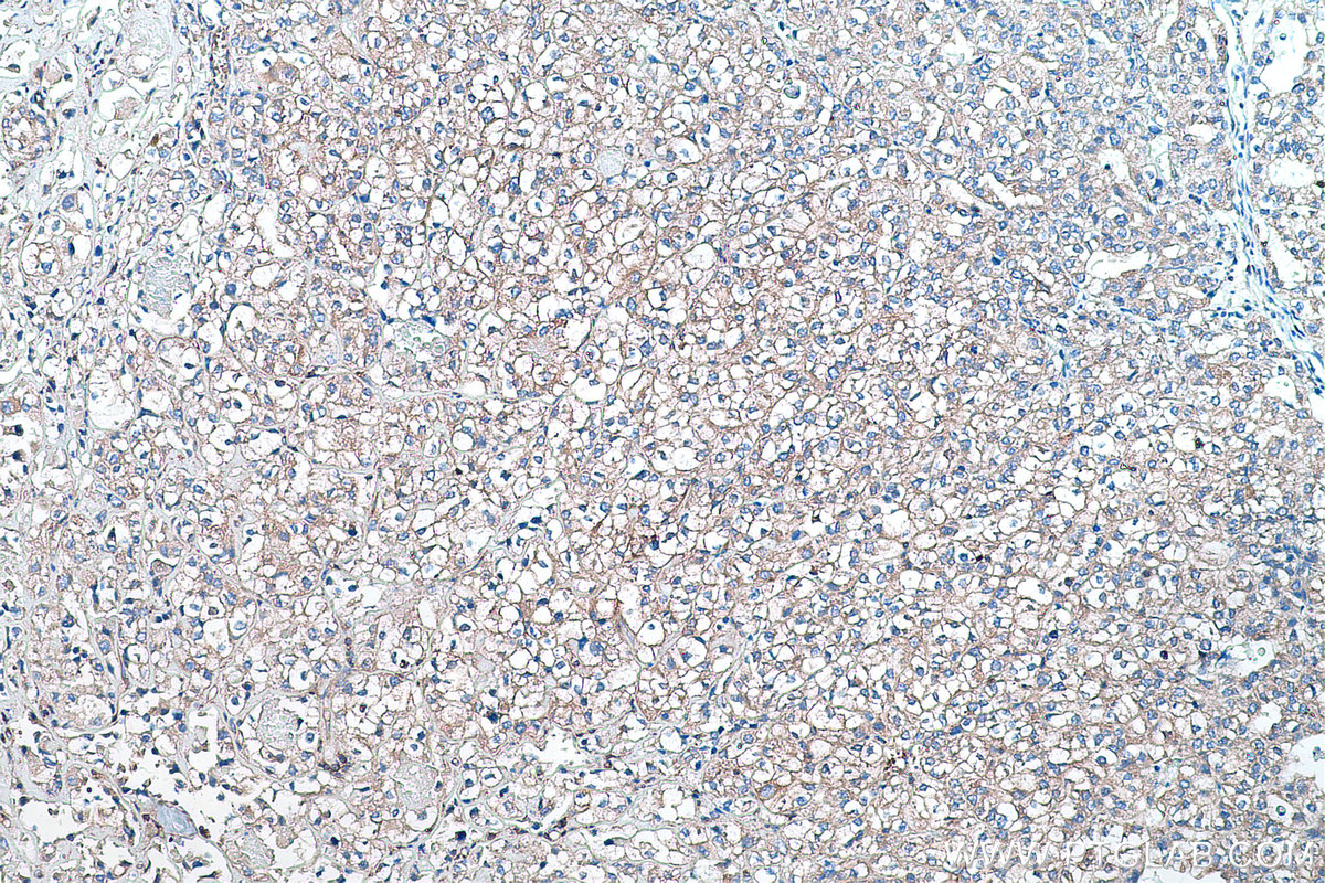 Immunohistochemical analysis of paraffin-embedded human endometrial cancer tissue slide using KHC0426 (HPRT1 IHC Kit).