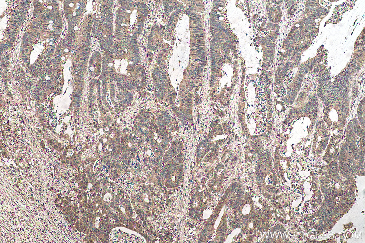 Immunohistochemical analysis of paraffin-embedded human colon cancer tissue slide using KHC0549 (Hsc70 IHC Kit).